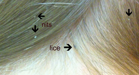 lice-eggssml